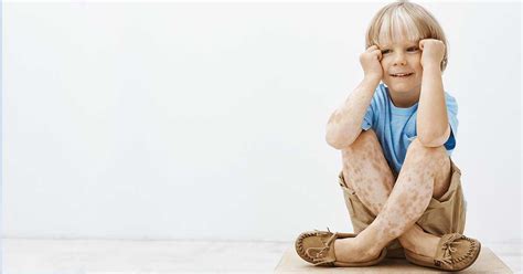 La Vitiligine Nei Bambini Fototerapia It