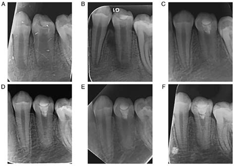 Follow Up Periapical Radiographs Of Tooth 35 A Preoperative