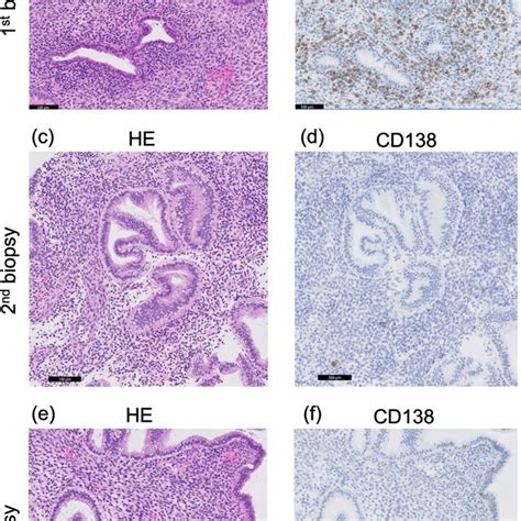 diagnosis  chronic endometritis based  histopathology findings