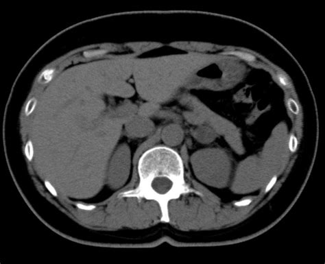 What Is the Contrast Dye Used in CT Scans? | HealDove