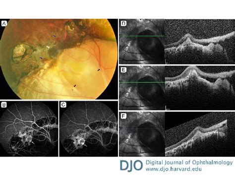 Choroidal Neovascular Membrane Diagram