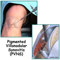 10 Pvns knee ideas | knee, rare disease, orthopedics