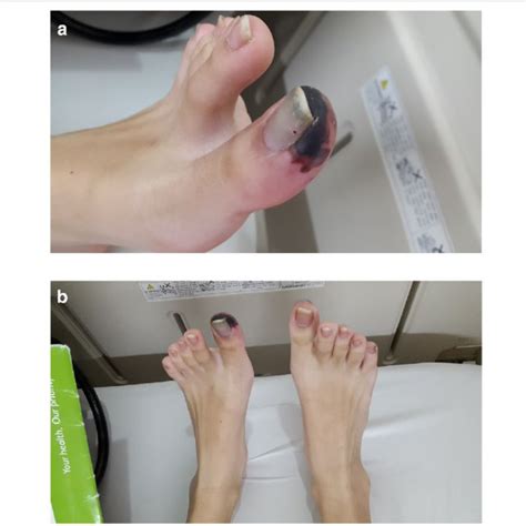 A Multiple Plain Old Balloon Angioplasty Dilatations B Flow After