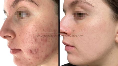 Acne Chicago Cosmetic Surgery And Dermatology