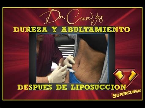 Liposucción y Efectos Secundarios Dr Cortes YouTube