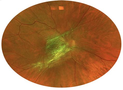 Epiretinal Membrane Macular Pucker Blue Coast Retina