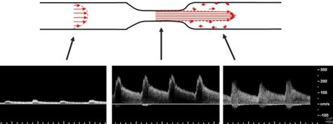 Flow Through A Stenosis Flow Waveforms Through A Carotid Stenosis