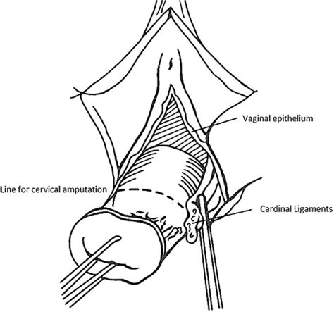 Vaginal Repair Fistulas Jcm Treatment Technique Rectovaginal Figure