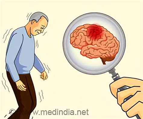 Parkinsons Diseases Clip Art Library