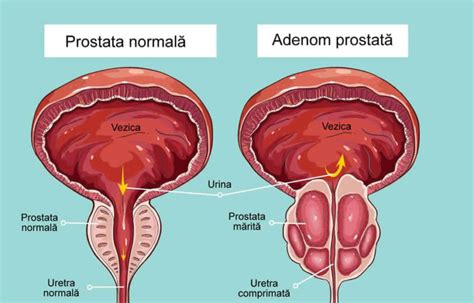 Cancer De Prostata Simptome Cauze Tratament E Urolog