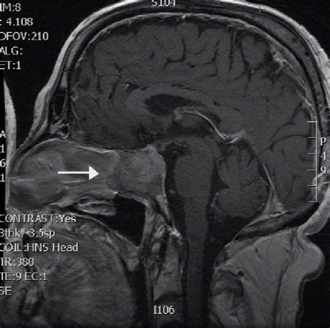 Contrast Enhanced Brain MRI T1 Weighted Sagittal Scans Intrasellar