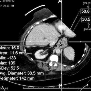 Normal anatomy of the esophageal hiatus shown with examples of ...