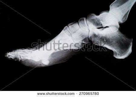 Anatomy Of Foot Bones X Ray : The Internal Architecture Of The Bone ...