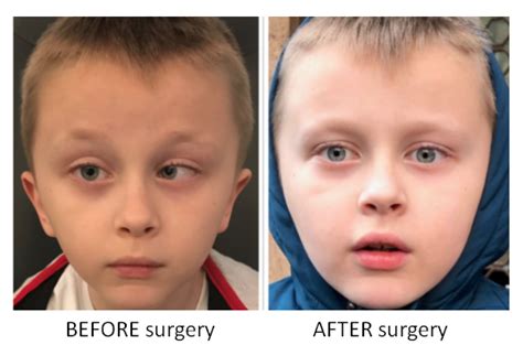 Amblyopia Surgery