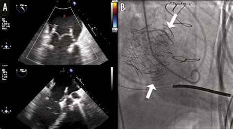 Percutaneous Transfemoral Transseptal Implantation Of A Second