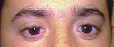 Bilateral Congenital Anophthalmia And Secondary Conjunctival Neoplasia Dalpasso Protesi Oculari