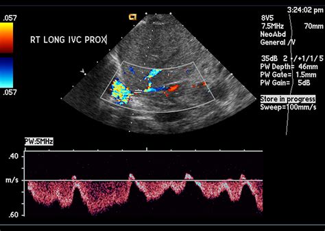 Normal Doppler Spectral Waveforms Of Major Pediatric Vessels Specific