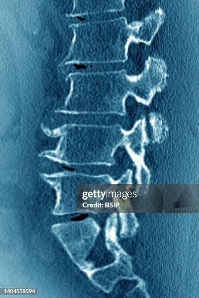 Degenerative Disc Disease Photos And Premium High Res Pictures Getty