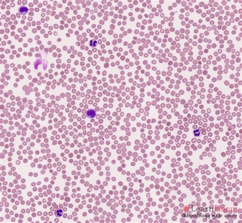 Chronic Myelomonocytic Leukaemia Learnhaem Haematology Made Simple