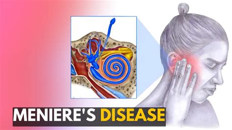 Meniere S Disease Everything You Need To Know YouTube