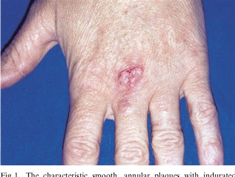 Granuloma Annulare Hands