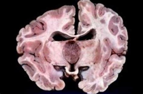 Pineoblastoma