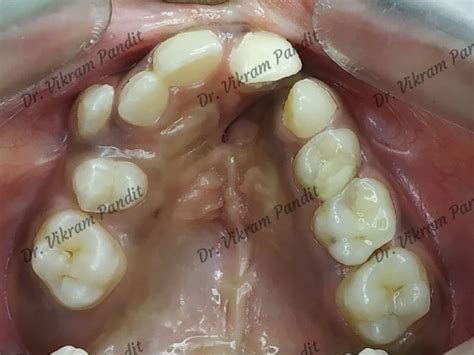 Alveolar Bone Grafting Overview Of Procedure