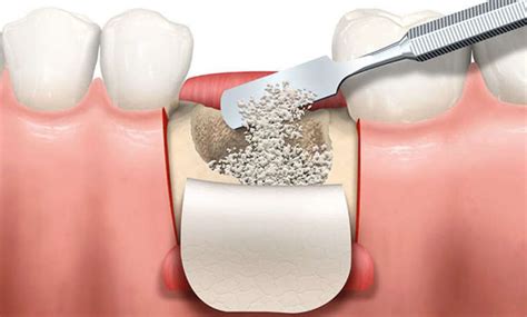 Regeneración Ósea Gae Odontólogos clínica dental en Córdoba