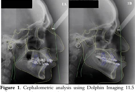 Figure 1 From Effect Of Orthognathic Surgery On Pharyngeal Airway Space