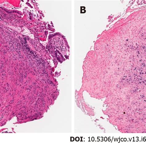 Epstein Barr Virus Associated Smooth Muscle Tumor In The Rectum In Case