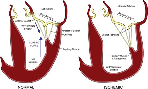 Ischemic Mitral Regurgitation An Intraoperative Echocardiographic