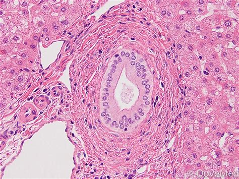 Primary Biliary Cholangitis Histology Hot Sex Picture