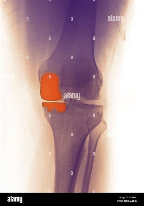 Knee X Ray Of A Year Old Man Showing A Partial Knee Replacement