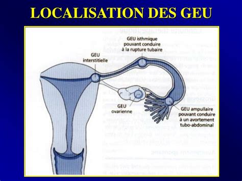 Ppt Signes Cliniques Et Volution De La Grossesse Extra Ut Rine