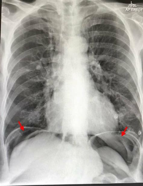 Chest X-ray showing air under the diaphragm suggestive of... | Download Scientific Diagram