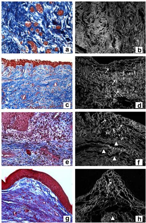 Massonâ€™s Trichrome Of Dental Follicle A Dentigerous Cyst Without