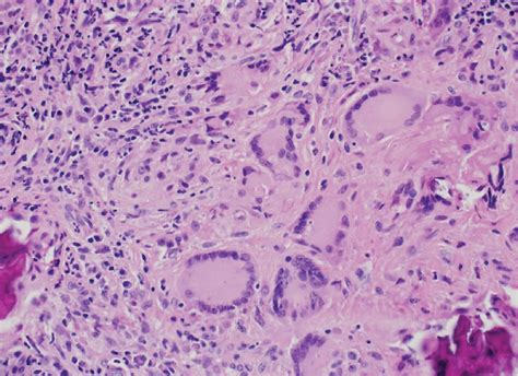 Histopathological Exam Of The Nasal Discharge Is Consistent With