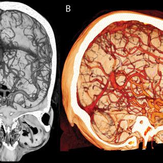 Three Dimensional Computed Tomography Angiography Reconstruction