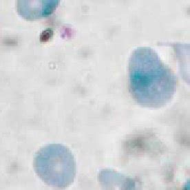 Peripheral blood smear showing teardrop cell, schistocytes ...