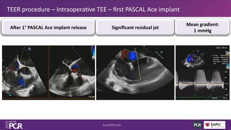 Tailoring Tricuspid Regurgitation Patient Treatment With The Pascal