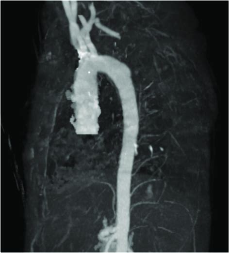 Three Dimensional Reconstruction Of Thoracic Aorta By Computed