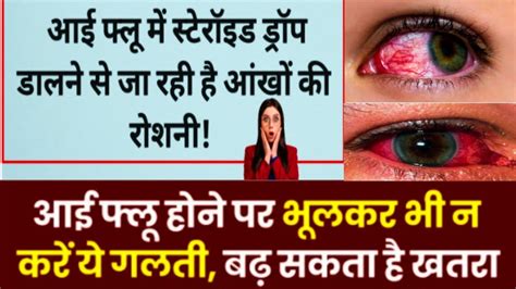 Avoid Steroids Eye Drops For Conjunctivitis Eye Flu