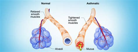 Bronchial Thermoplasty for Asthma Treatment - NYC Lung Doctors