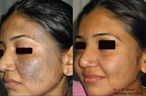 Nevus Of Ota Before And After Q Switched Ndyag 1064 Nm Open I