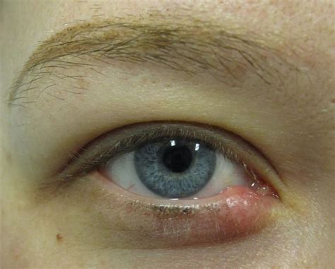 Stye Eye: How Long Does a Stye last on your eye - Daily Medicos