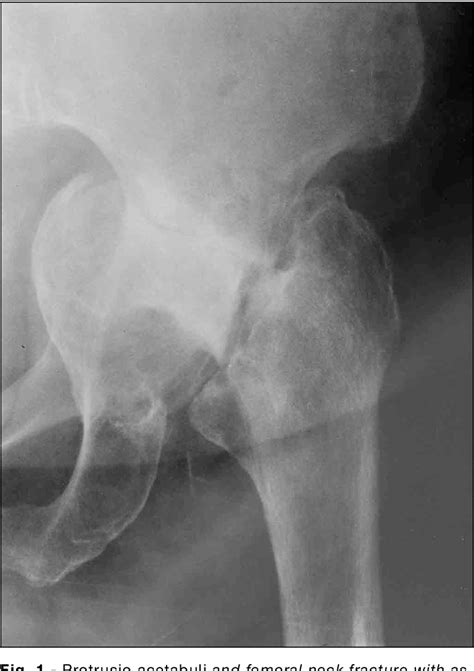 Femoral Neck Fracture Complicating Protrusio Acetabuli Semantic Scholar