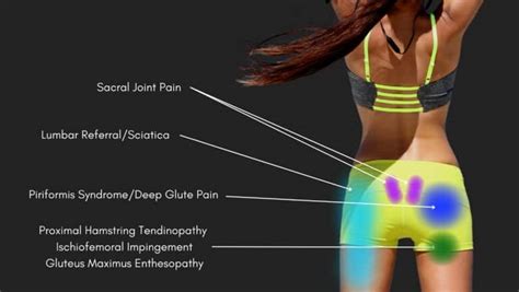 Hip Pain Location Diagram | Hip Pain Location Chart