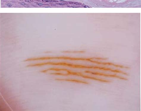 Figure 1 From Dermoscopy In The Diagnosis Of Tinea Nigra Plantaris Semantic Scholar