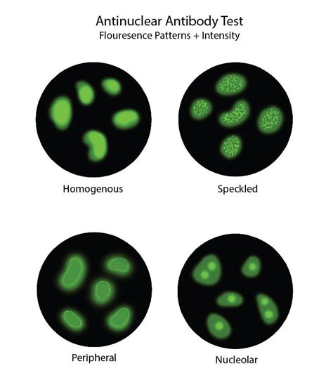 Biochemistry Antinuclear Antibodies Ana Statpearls Ncbi Bookshelf