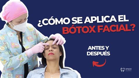 Sesi N B Tox Facial Tercio Superior Paso A Paso El Final Es Lo